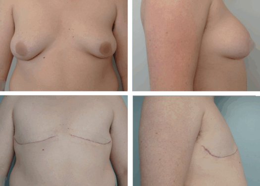 Top Surgery Portland Oregon by Dr. Tina Jenq
